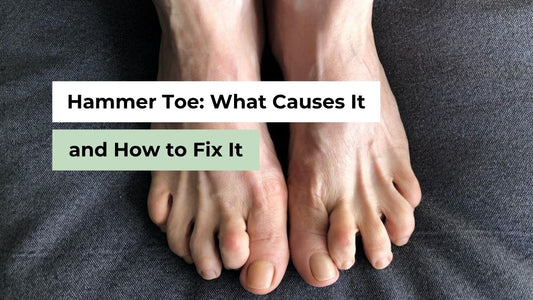 Hammer Toe: What Causes It and How to Fix It 