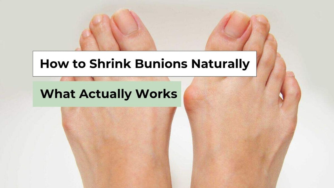 How to Shrink Bunions Naturally: What Actually Works
